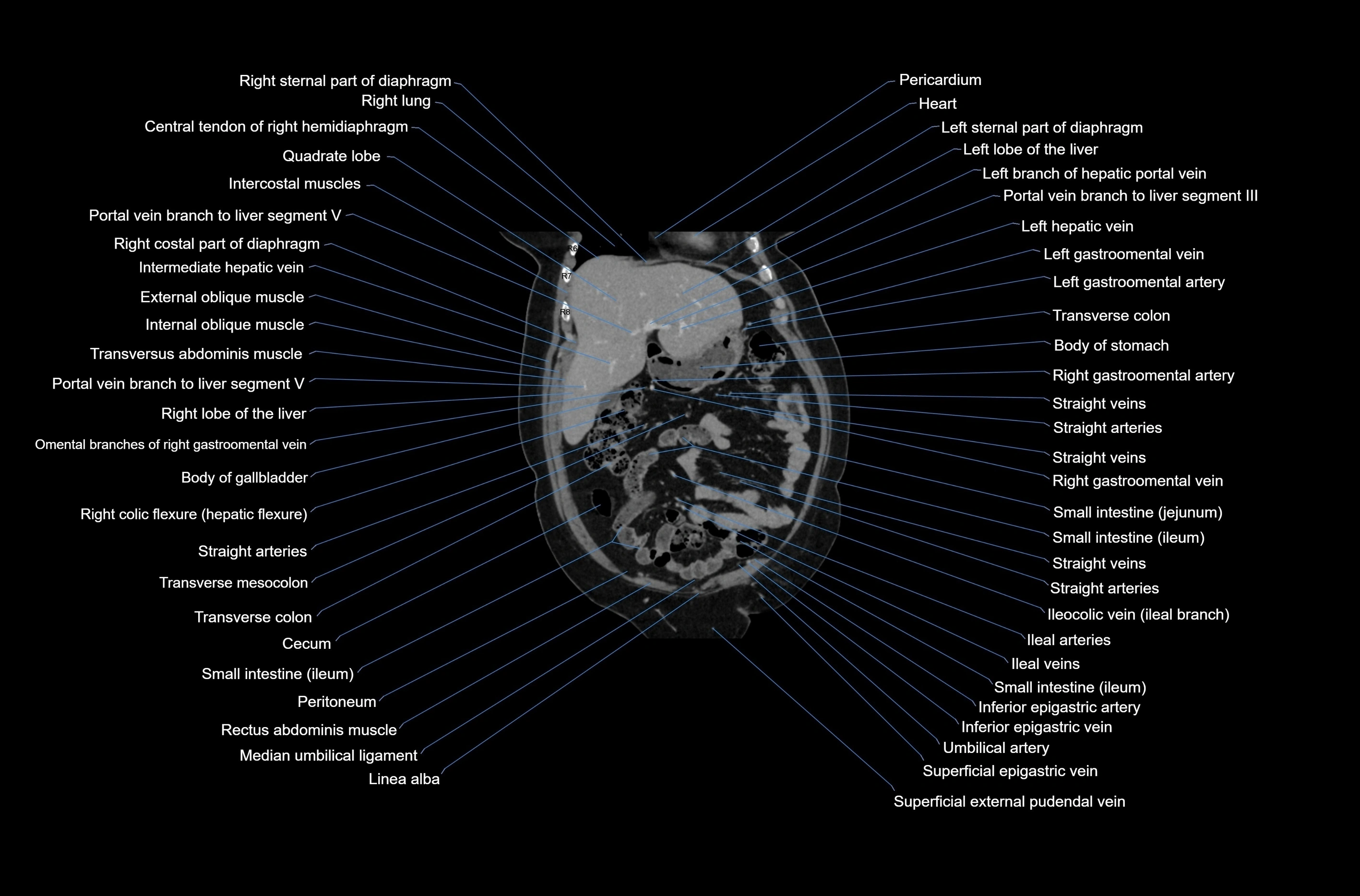 CT abdomen coronal cross sectional anatomy labelled radiology image-00022.webp